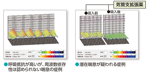 総合呼吸抵抗測定装置 結果